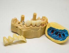 Wisdom Tooth Removal- Why is it a Wise Decision?
